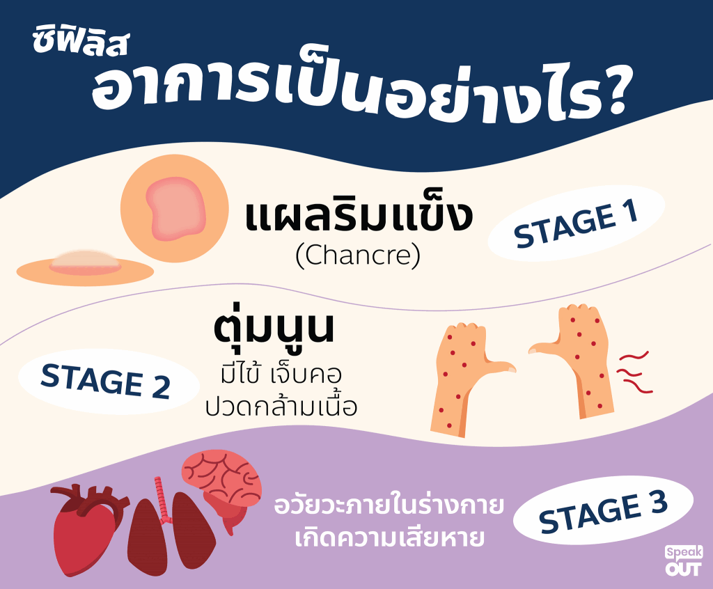 ซิฟิลิสอาการเป็นอย่างไร