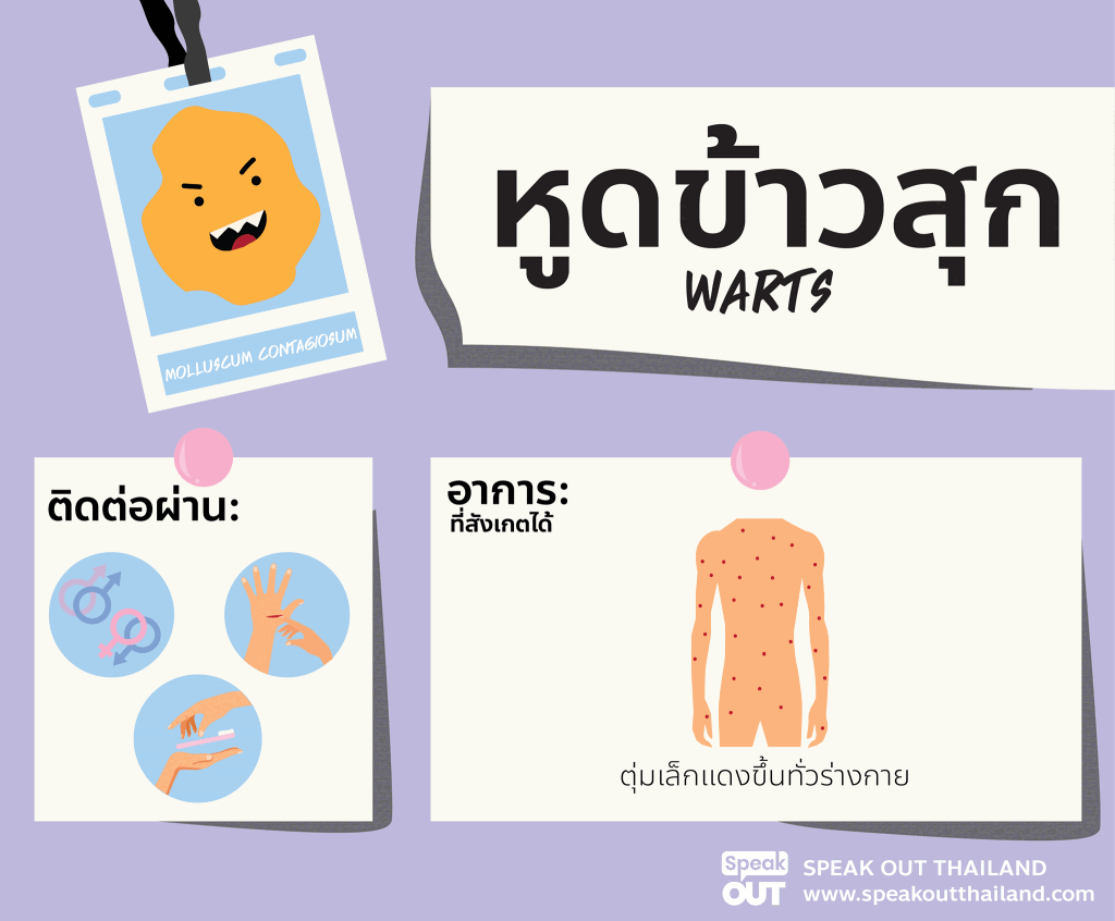 หูดข้าวสุก